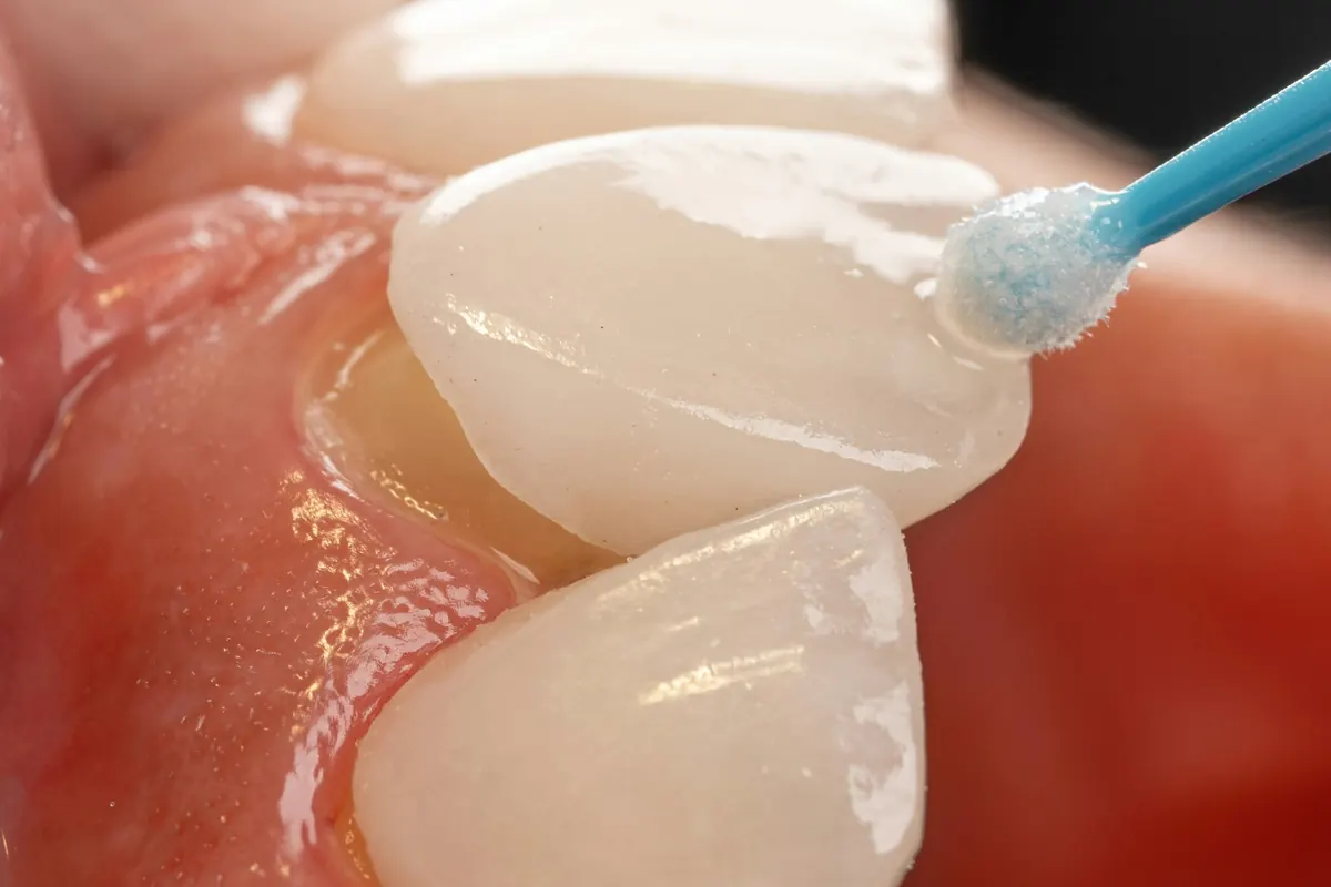 A tooth being prepared for a restoration