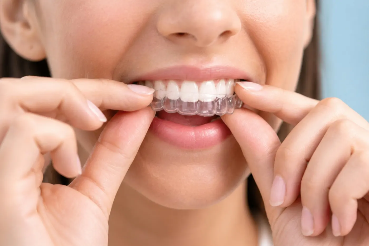 A clear aligner being fitted over the upper teeth