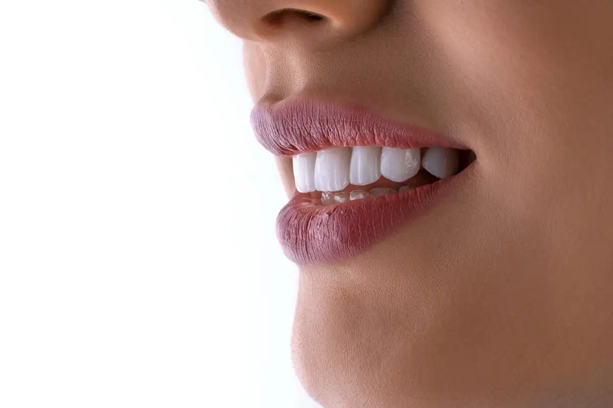 Close up of a smile after whitening, with a clear whitening tray on the lower teeth